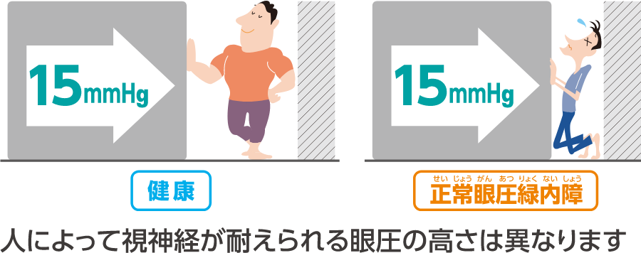 正常眼圧緑内障とは