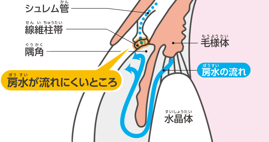 解放隅角緑内障