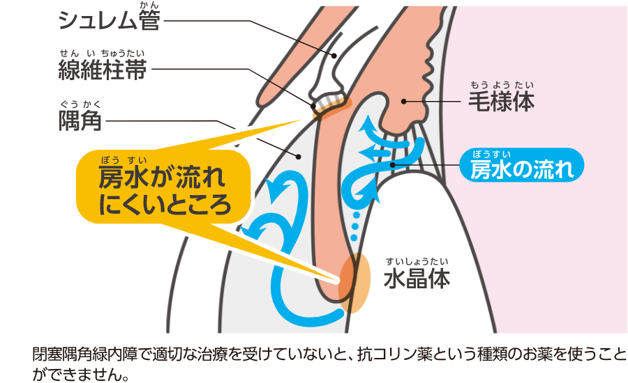 閉塞隅角緑内障