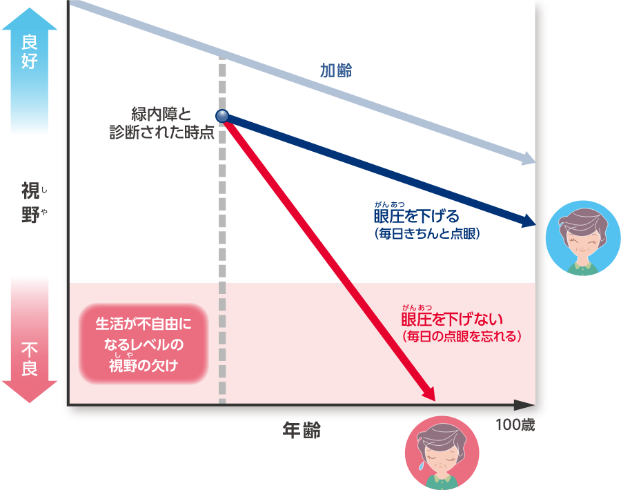 視野と眼圧の関係