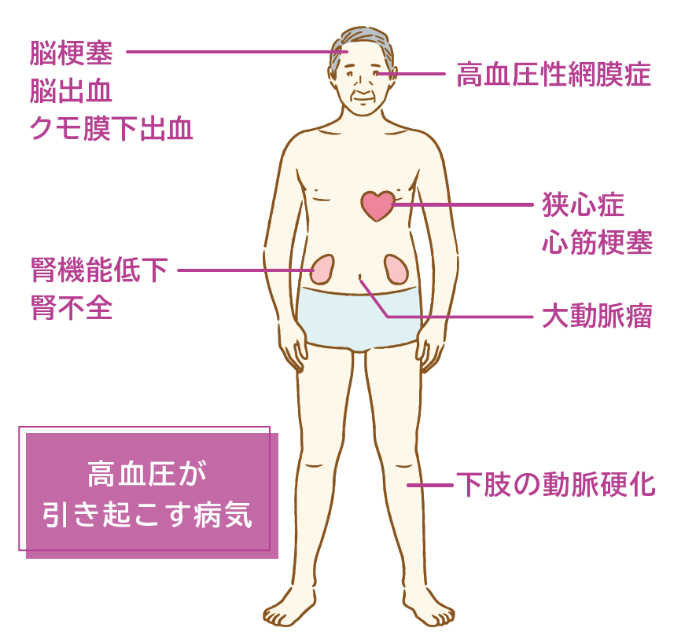 高血圧が引き起こす病気