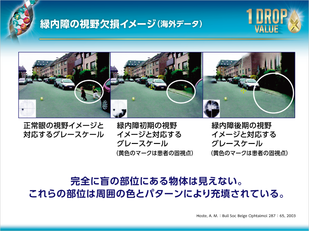 緑内障の視野欠損イメージ（海外データ）