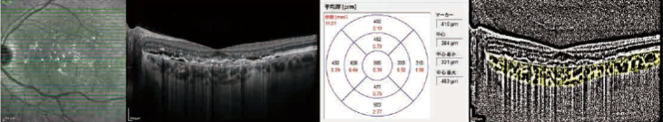 図B.滲出型AMDの眼における脈絡膜厚と脈絡膜容積