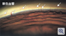 画像所見（新生血管）