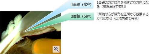 1面鏡（62°） 1面鏡の方が隅角を覗きこむ方向になる（狭隅角眼で有利）
                            3面鏡 3面鏡の方が隅角を正面から観察する方向になる（広隅角眼で有利）