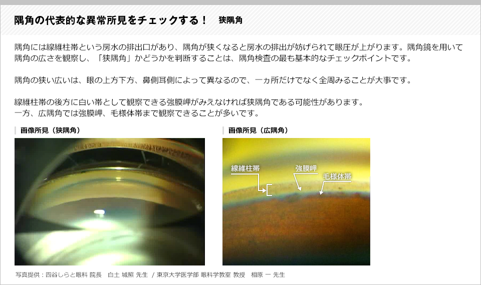 隅角の代表的な異常所見をチェックする2