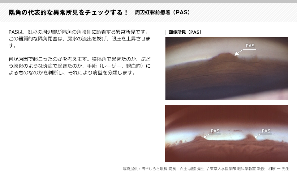 隅角の代表的な異常所見をチェックする4