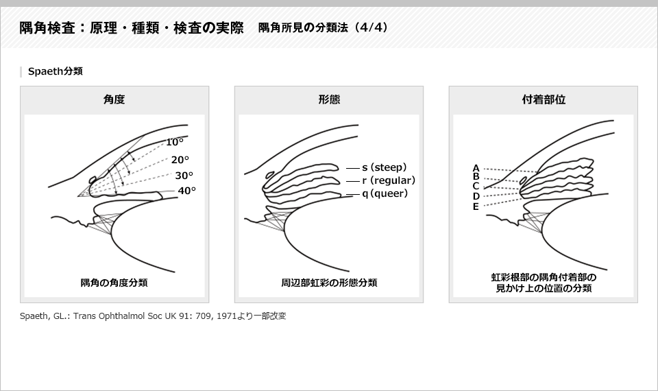 隅角検査：原理・種類・検査の実際11