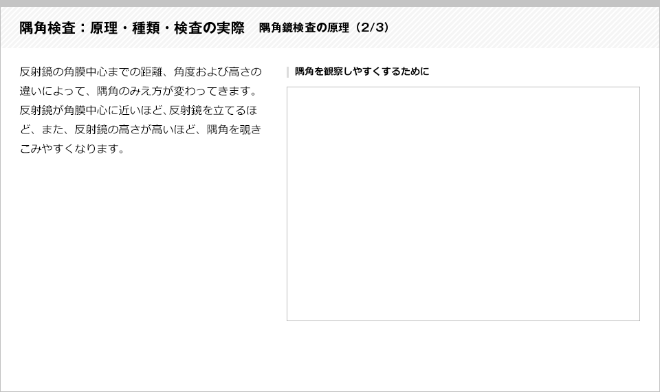 隅角検査：原理・種類・検査の実際2