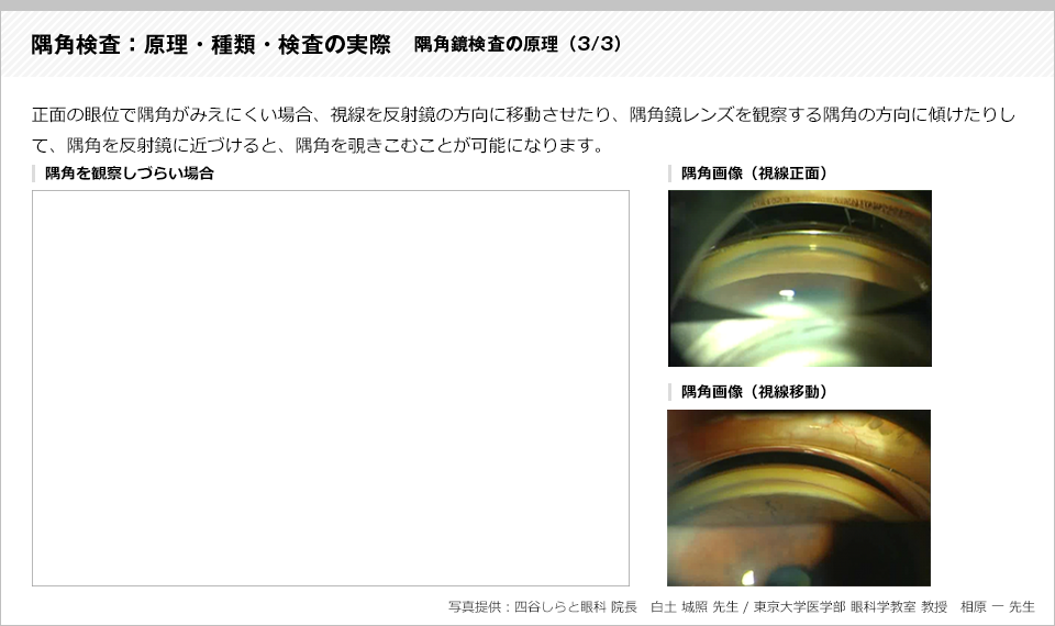 隅角検査：原理・種類・検査の実際3