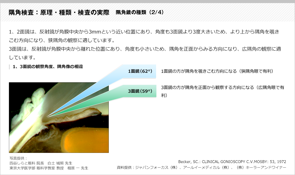 隅角検査：原理・種類・検査の実際5