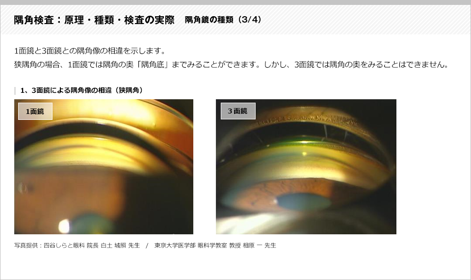 隅角検査：原理・種類・検査の実際6