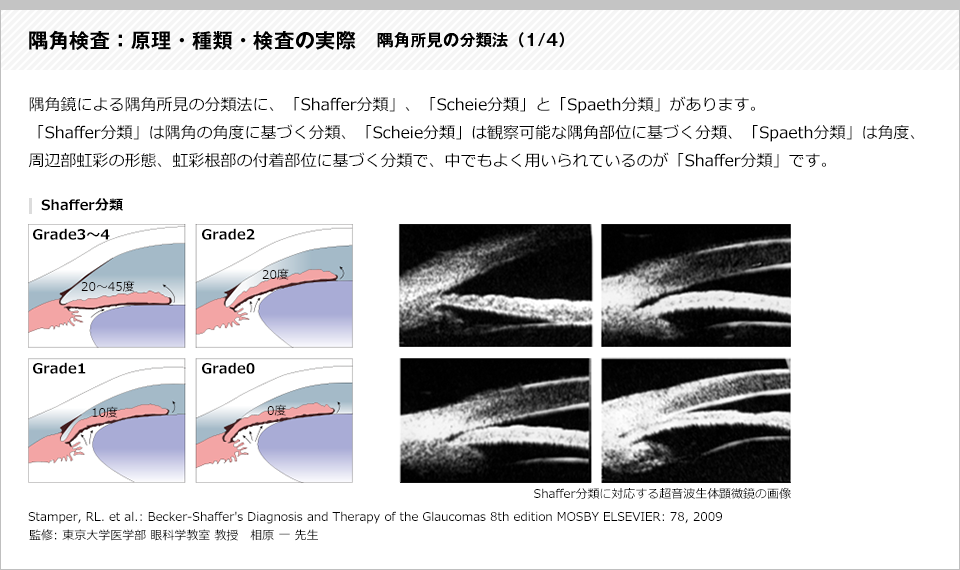 隅角検査：原理・種類・検査の実際8